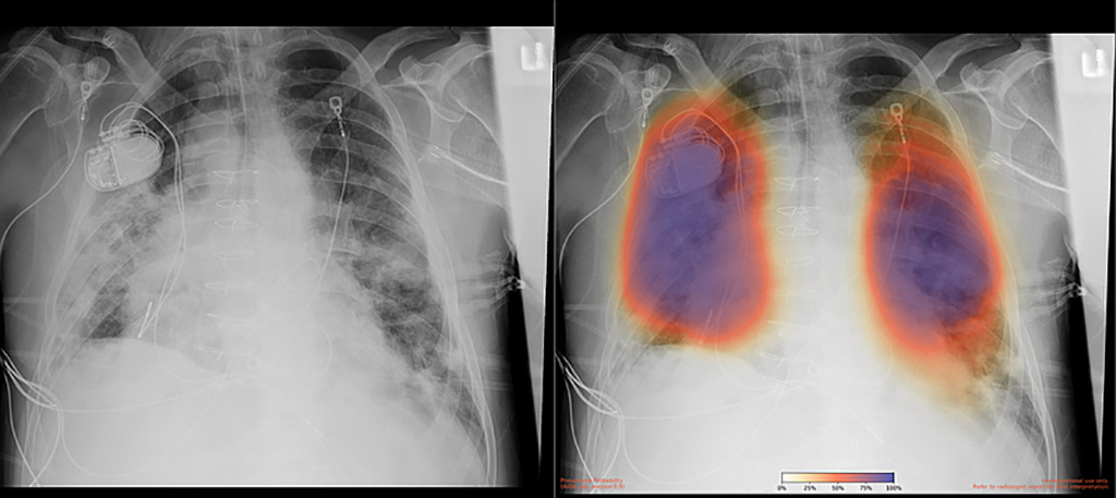 Imagen: Radiografía de tórax de un paciente con neumonía por COVID-19, radiografía original (izquierda) y resultado con IA para neumonía (derecha) (Fotografía cortesía de UC San Diego Health)