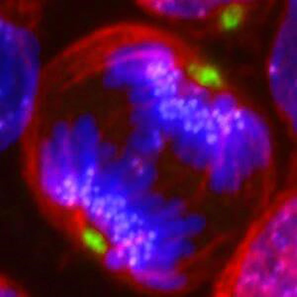 Imagen: Imagen de microscopio confocal de una muestra de leucemia linfoide aguda de células B hiperdiploides (LLA-B) teñida con tubulina (rojo), pericentrina (verde), centrómeros (púrpura) y ADN (azul) (Fotografía cortesía de Óscar Molina).