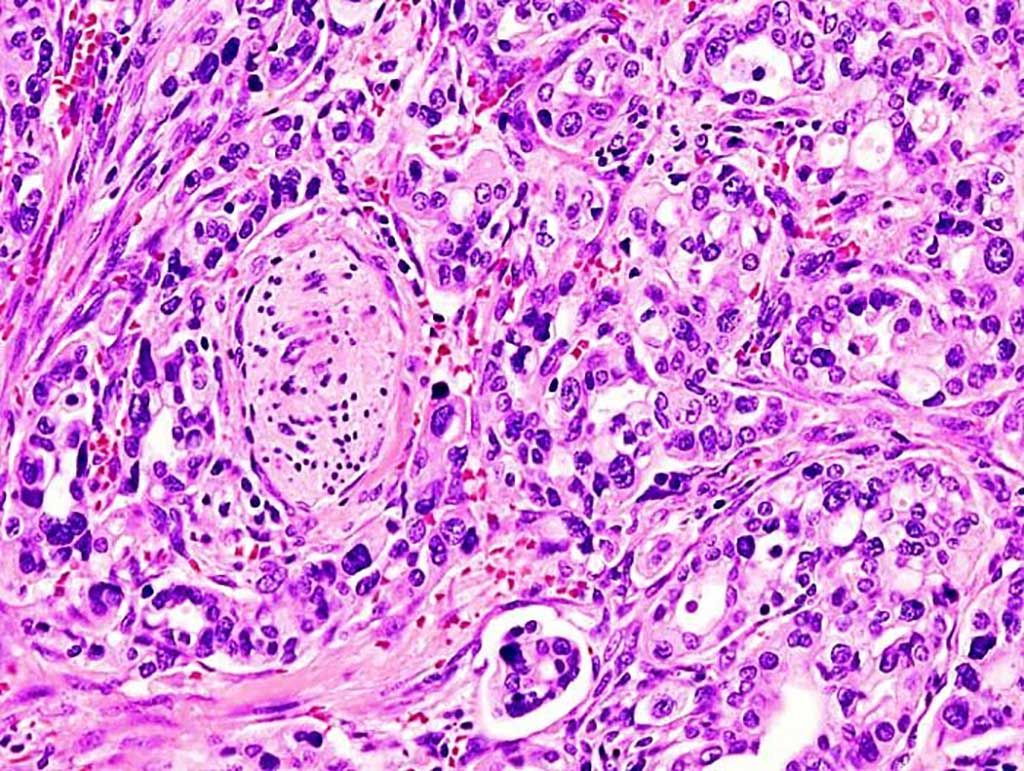 Imagen: Microfotografía histopatológica de adenocarcinoma pancreático que surge en la región de la cabeza del páncreas (Fotografía cortesía de KGH).