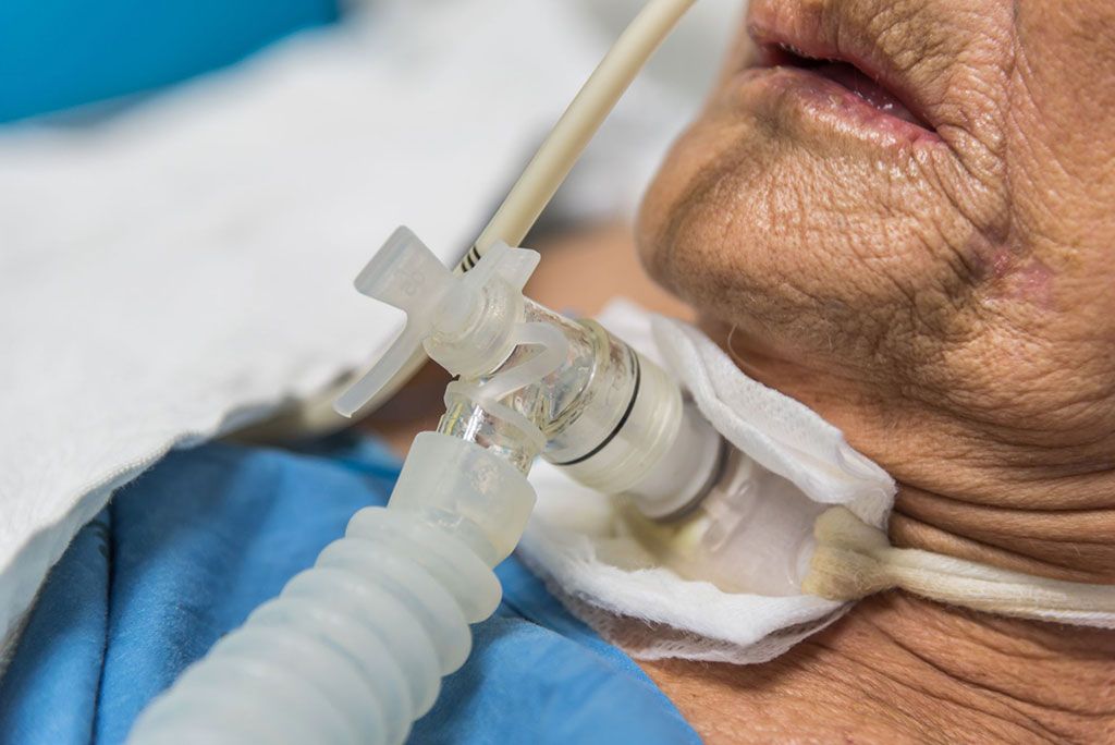 Pacientes Ventilados De Covid 19 Se Podrian Beneficiar Con Una Traqueotomia Covid 19 Labmedica Es
