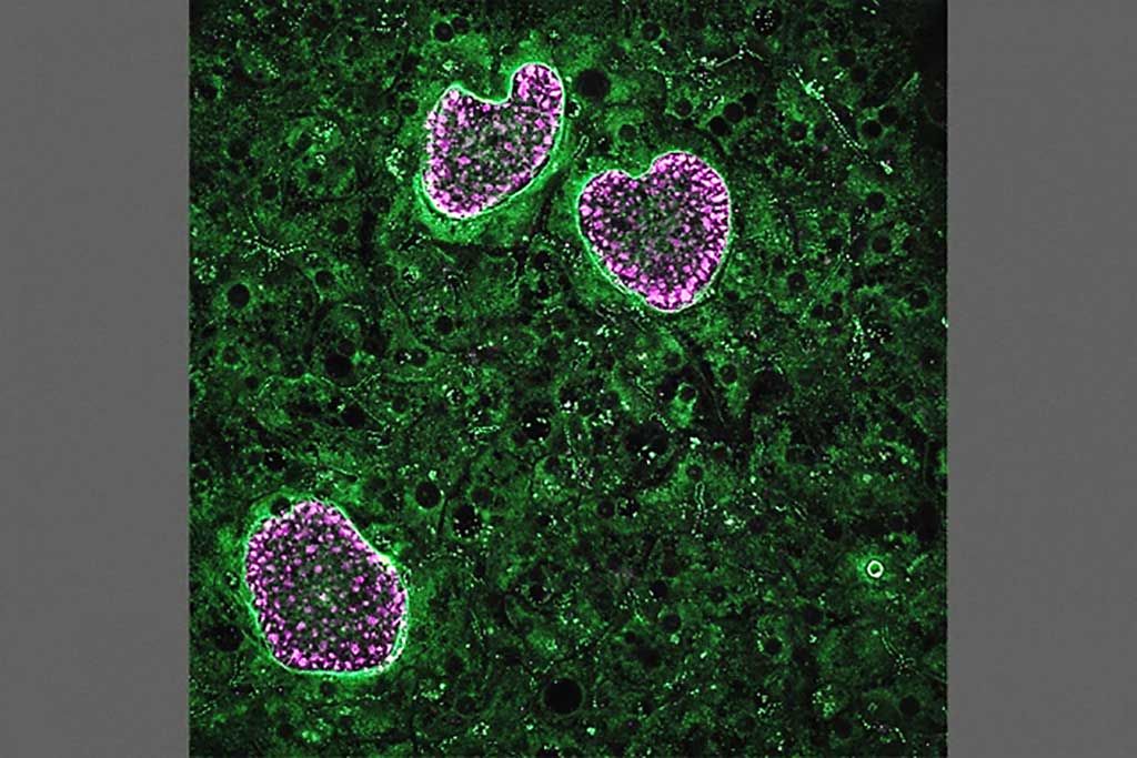 Imagen: Cuatro parásitos de Plasmodium vivax que han invadido hepatocitos humanos. Tres de los parásitos están en desarrollo, mientras que un parásito, en la parte inferior izquierda, es un hipnozoito latente, que permanece pequeño hasta su reactivación (Fotografía cortesía de Nil Gural).