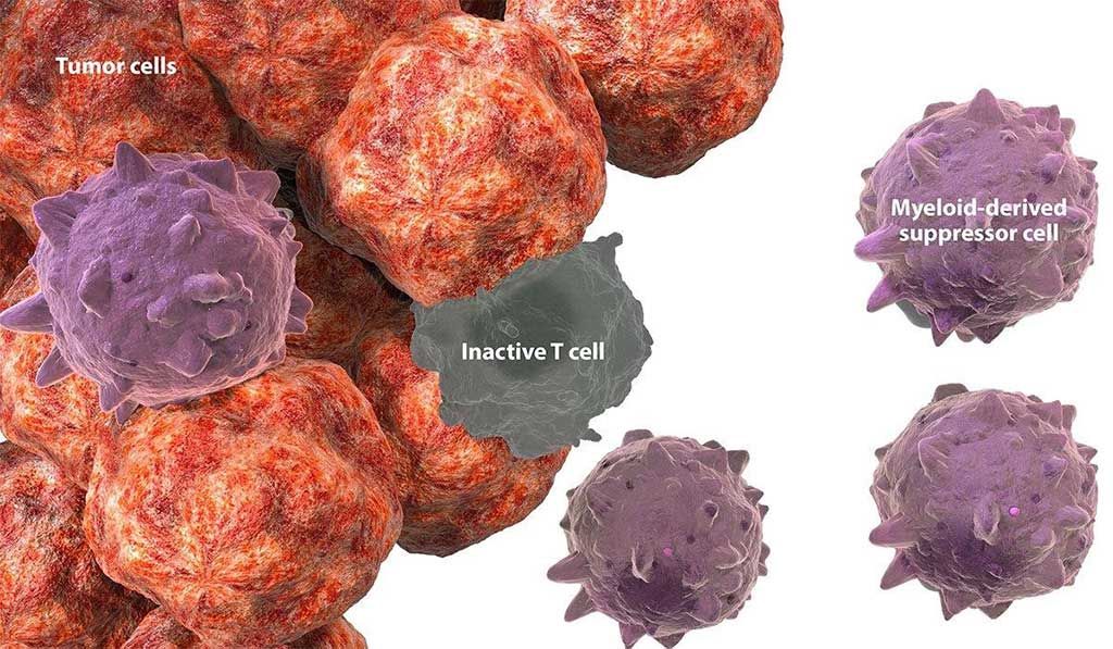 Imagen: Se han observado células supresoras derivadas de células mieloides en el microambiente tumoral en una variedad de tumores sólidos (Fotografía cortesía de BMS Immuno-Oncology).