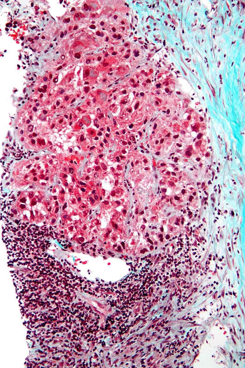 Imagen: Microfotografía del carcinoma hepatocelular (cáncer de hígado) (Fotografía cortesía de Wikimedia Commons)
