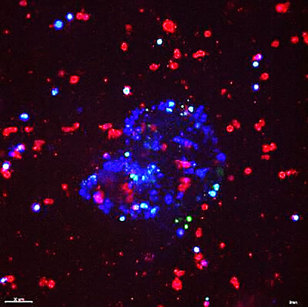 Imagen: Un organoide tumoral azul rodeado de células NK rojas (Fotografía cortesía de Isaac Chan, MD, PhD).