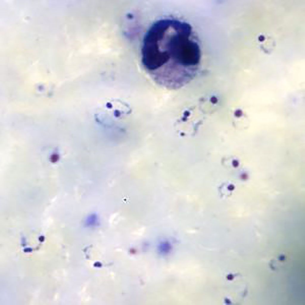 Imagen: Trofozoítos en forma de anillo de Plasmodium falciparum y un glóbulo blanco en un extendido de gota gruesa (Fotografía cortesía de Medical Care Development International).