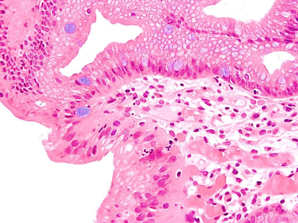 Imagen: Microfotografía de la histopatología del esófago de Barrett que muestra las células características caliciformes (coloración de azul de Alciano) (Fotografía cortesía de Nephron)