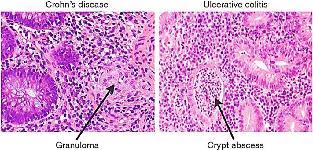 Imagen: Comparación de la histología entre la colitis ulcerativa y la enfermedad de Crohn (Fotografía cortesía de R. J. Xavier y D. K. Podolsky).