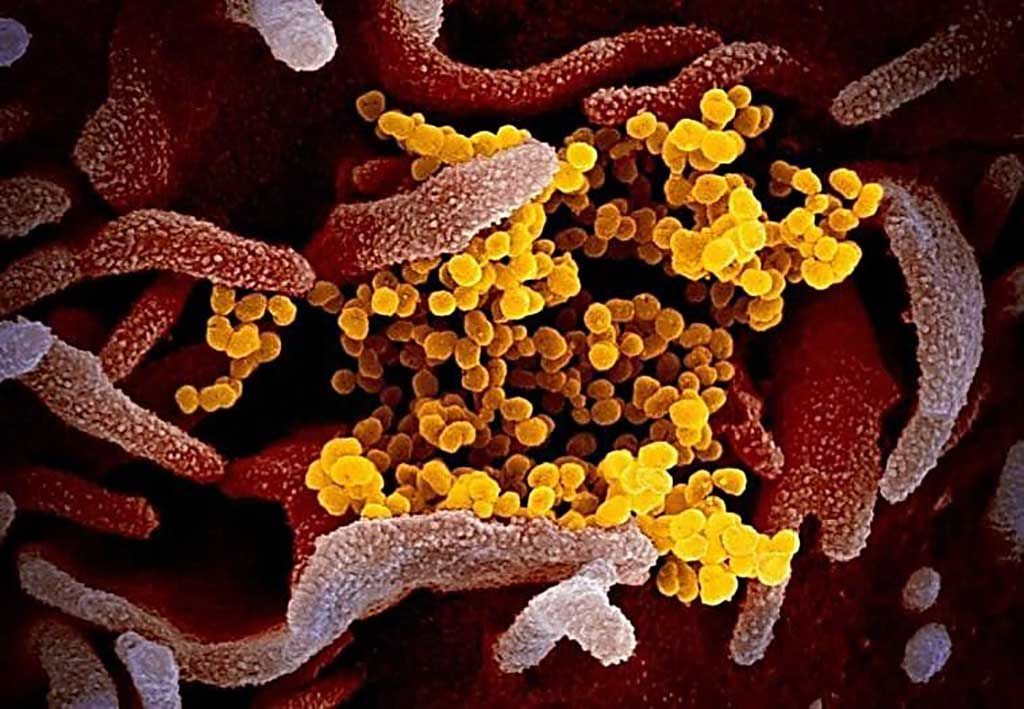 Imagen: La imagen del microscopio electrónico de barrido muestra el SARS-CoV-2 (amarillo), el virus que causa el COVID-19, aislado de un paciente en los EUA, emergiendo de la superficie de las células (rosa) cultivadas en el laboratorio (Fotografía cortesía de NIAID- RML).