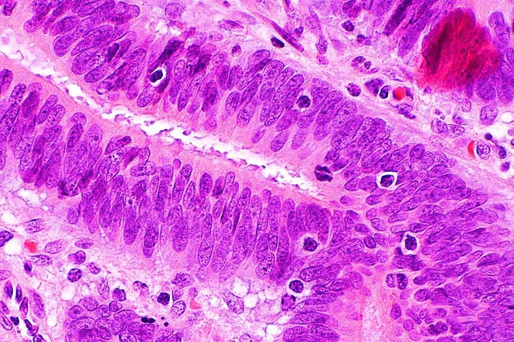 Imagen: Microfotografía que muestra linfocitos infiltrantes de tumores en el carcinoma colorrectal que sugieren inestabilidad de los microsatélites (Fotografía cortesía de Nephron).