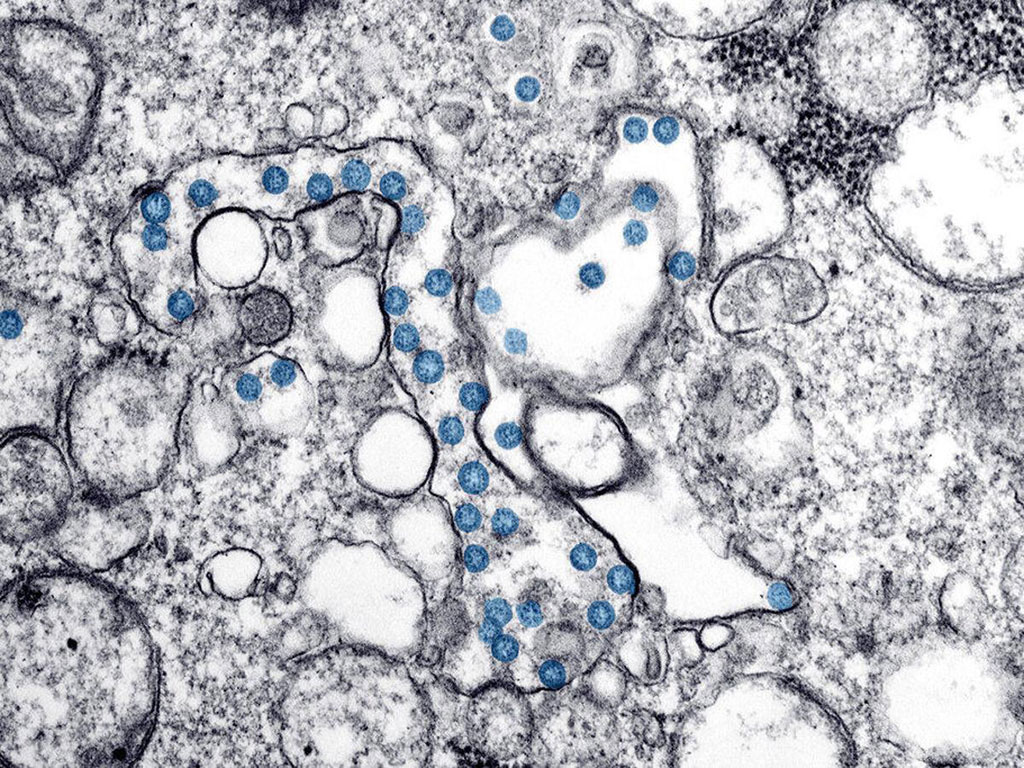 Imagen: Partículas virales del SARS-CoV-2 (azul) en un aislado clínico. (Fotografía cortesía de los CDC)