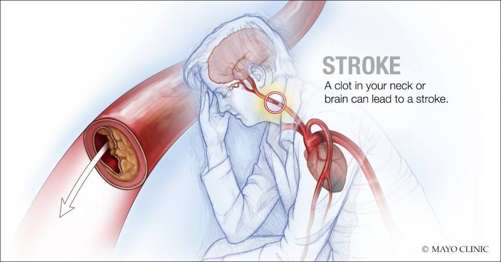 Imagen: Un coágulo en el cuello o el cerebro puede provocar un derrame cerebral (Fotografía cortesía de Mayo Clinic)