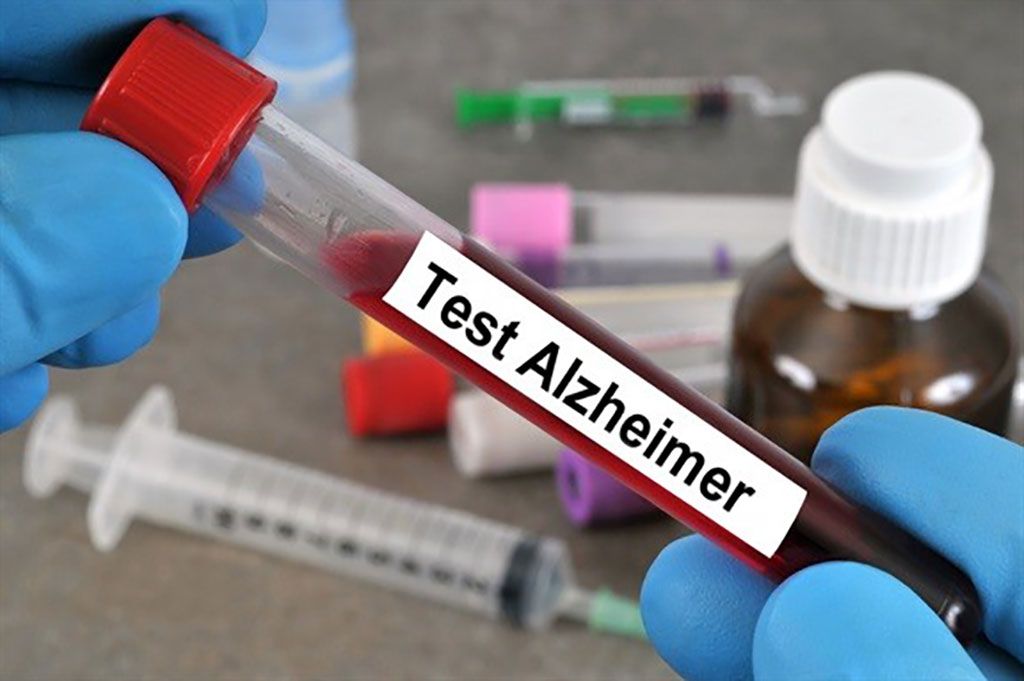 Imagen: Un aumento en P-tau217 en plasma puede ser considerado como un biomarcador temprano de la enfermedad de Alzheimer (Fotografía cortesía de la Facultad de Medicina de Harvard).