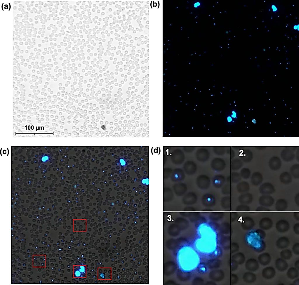 Imagen: Campo de visión microscópico que muestra la detección de parásitos P. falciparum en frotis delgados coloreados con DAPI: (1) glóbulos rojos infectados (RBC), (2) glóbulos rojos normales, (3) leucocitos y (4) desechos fluorescentes (Fotografía cortesía de Universidad de Helsinki).