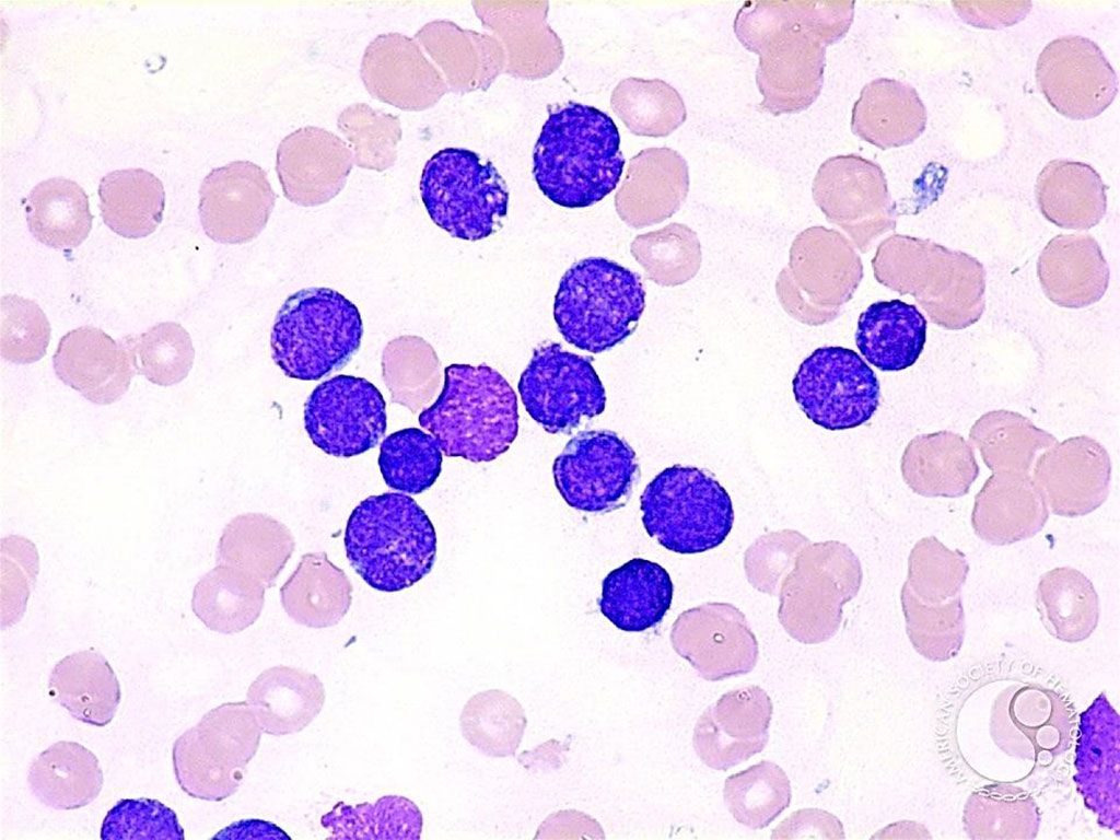 Imagen: Leucemia linfoide aguda: los linfoblastos parecen pequeños con un borde delgado de citoplasma (Fotografía cortesía de Peter Maslak MD).
