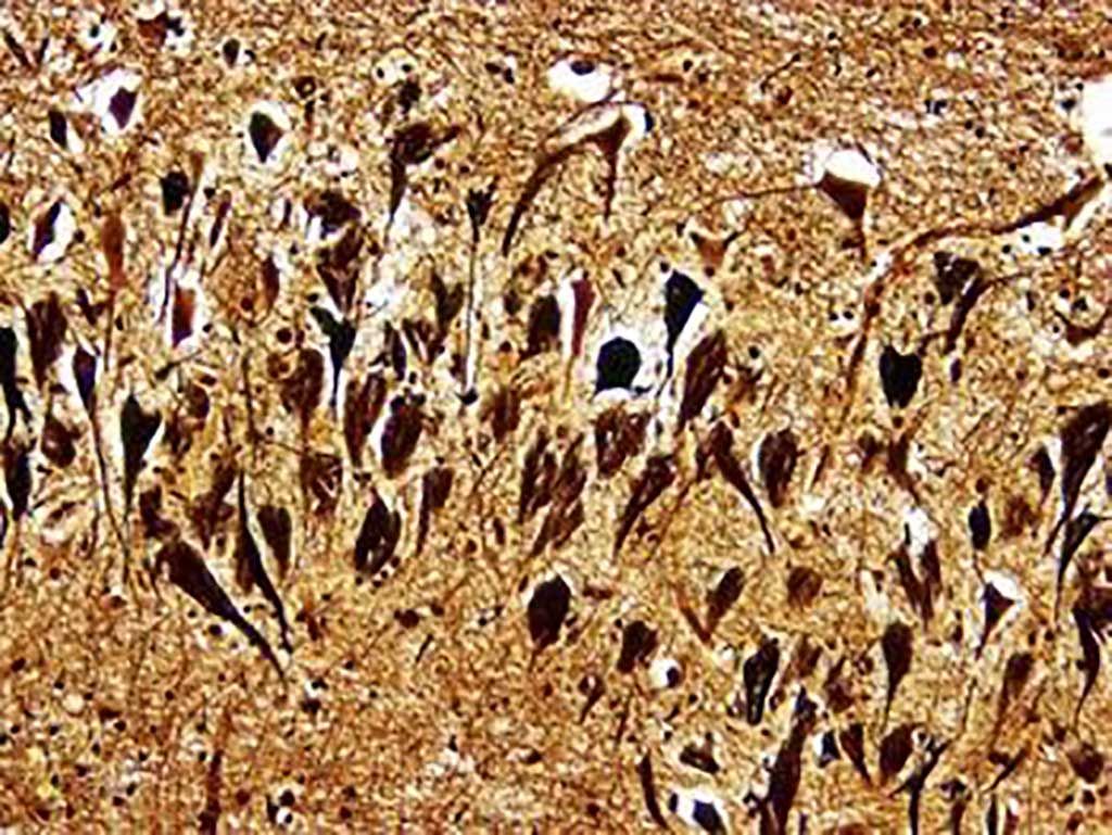 Imagen: Histopatología de ovillos neurofibrilares en el cerebro de un paciente con enfermedad de Alzheimer (coloración de plata de Bielschowski) (Fotografía cortesía de Dimitri P. Agamanolis, MD).