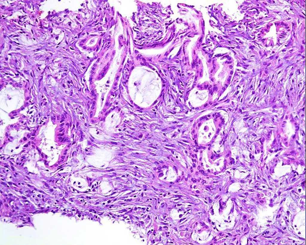 Imagen: Las microfotografía de los nódulos omentales mostraron un adenocarcinoma que infiltraba los tejidos adiposo y fibroso (Fotografía cortesía del Hospital Shijitan de Beijing).