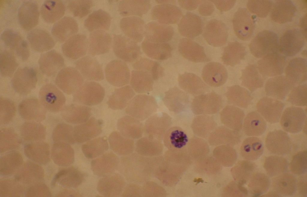 Imagen: Extendido de sangre de un cultivo de P. falciparum: varios glóbulos rojos tienen etapas de anillo en su interior, mientras que cerca del centro hay un esquizonte y a la izquierda un trofozoíto (Fotografía cortesía de Wikimedia Commons)