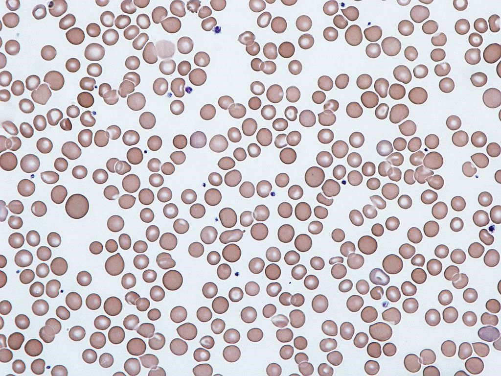 Imagen: Eritrocitos humanos que muestran una variación en el ancho de distribución de los glóbulos rojos (ADE), conocida como anisocitosis; niveles más altos pueden predecir la mortalidad en pacientes con COVID-19 (Fotografía cortesía del Dr. Graham Beards)