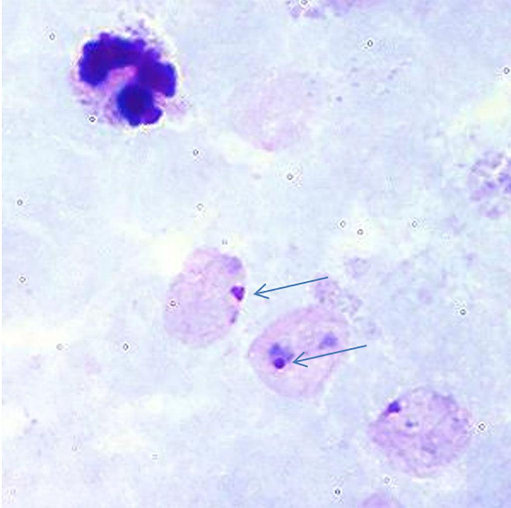 Imagen: Paludismo: frotis de sangre de gota gruesa que muestra trofozoítos anulares de Plasmodium vivax que son difíciles de detectar. Hay dos formas de anillo marcadas con flechas (Fotografía cortesía de los Centros de Control y Prevención de Enfermedades de EUA).