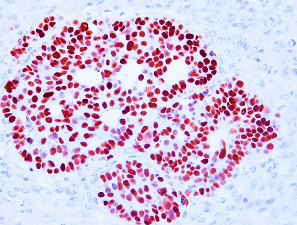 Imagen: Imagen histopatológica de un paciente con síndrome de Li Fraumeni que muestra acumulación de TP53 mutante en las células tumorales (Fotografía cortesía de Thierry Soussi, PhD).