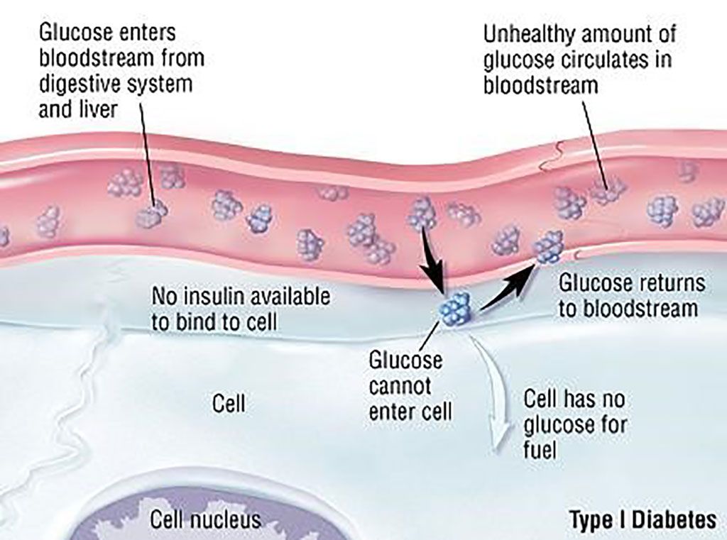 Imagen: Diagrama esquemático de la diabetes tipo 1 (DT1). La respuesta inmune a la insulina podría identificar y ayudar a tratar a las personas en riesgo de DT1 (Fotografía cortesía de la Facultad de Medicina de Harvard).