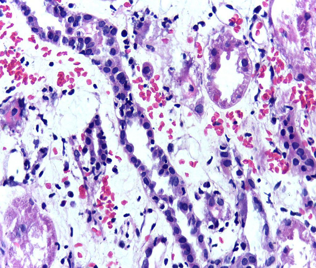 Imagen: La presencia de linfocitos dentro del epitelio tubular es una de las características patológicas del rechazo celular agudo de un trasplante de riñón (Fotografía cortesía de Wikimedia Commons)