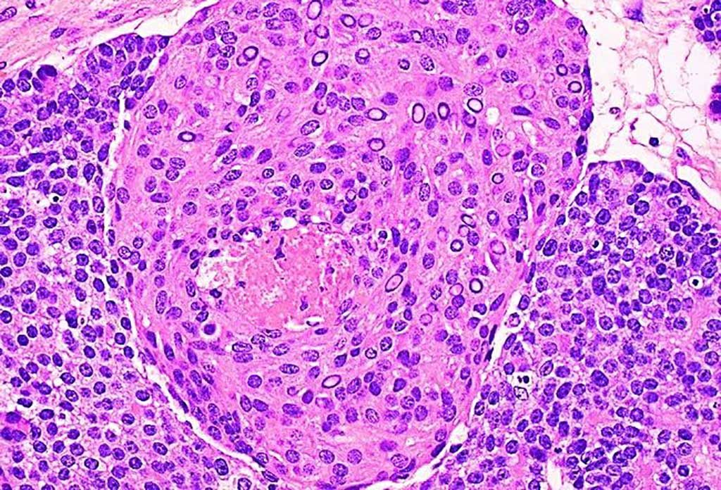 Imagen: Histopatología del pancreatoblastoma que muestra un gran nido de escamoides rodeado por una capa de células monomórficas amorfas. Muchos de los núcleos de células escamosas son ópticamente transparentes debido a la acumulación de biotina (Fotografía cortesía de Dharam Ramnani, MD).