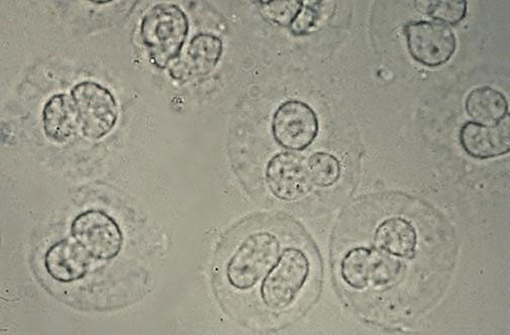 Imagen: Glóbulos blancos en la orina de un paciente con bacteriuria y piuria, una infección del tracto urinario. Las células tienen núcleos lobulados y gránulos citoplásmicos refráctiles (Fotografía cortesía de la Facultad de Medicina de la Universidad de Utah).