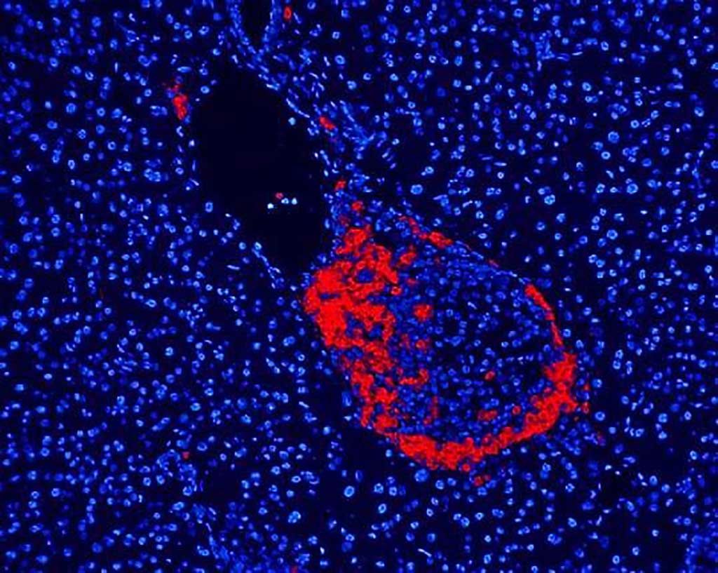 Imagen: La inflamación de los islotes pancreáticos con células mononucleares, incluidas las células T, es el sello distintivo de la diabetes tipo 1 (Fotografía cortesía de A. van Halteren)