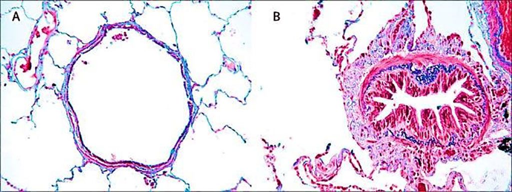 Imagen: Comparación histológica de las características de las vías respiratorias en (A) un individuo sano y (B) en un paciente con enfermedad pulmonar obstructiva crónica, donde las vías respiratorias se estrechan por la infiltración de células inflamatorias, hiperplasia mucosa y depósito de tejido conectivo en el espacio peribronquiolar (Fotografía cortesía de Universidad de Lovaina)