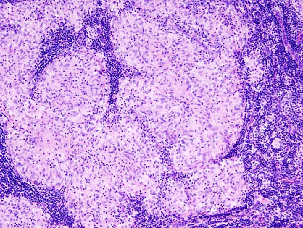Imagen: Imagen histopatológica de sarcoidosis en una biopsia de ganglio linfático (Fotografía cortesía de Wikimedia Commons)