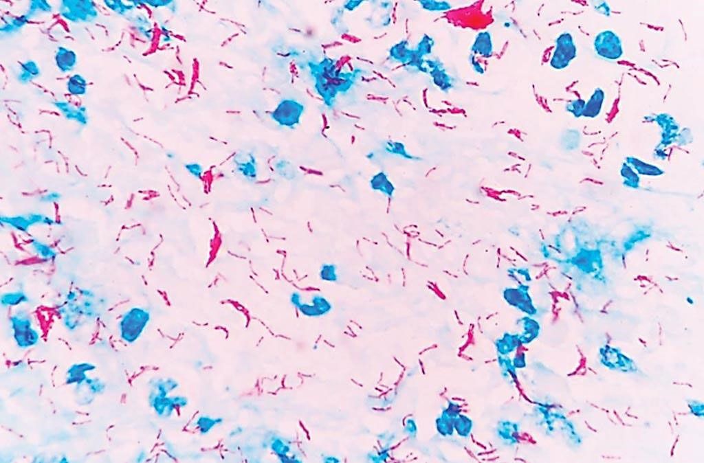 Imagen: Microfotografía de Mycobacterium tuberculosis -La coloración ácido alcohol resistente de Ziehl-Neelsen colorea a las bacterias de rojo (Fotografía cortesía de la Universidad Rockefeller)