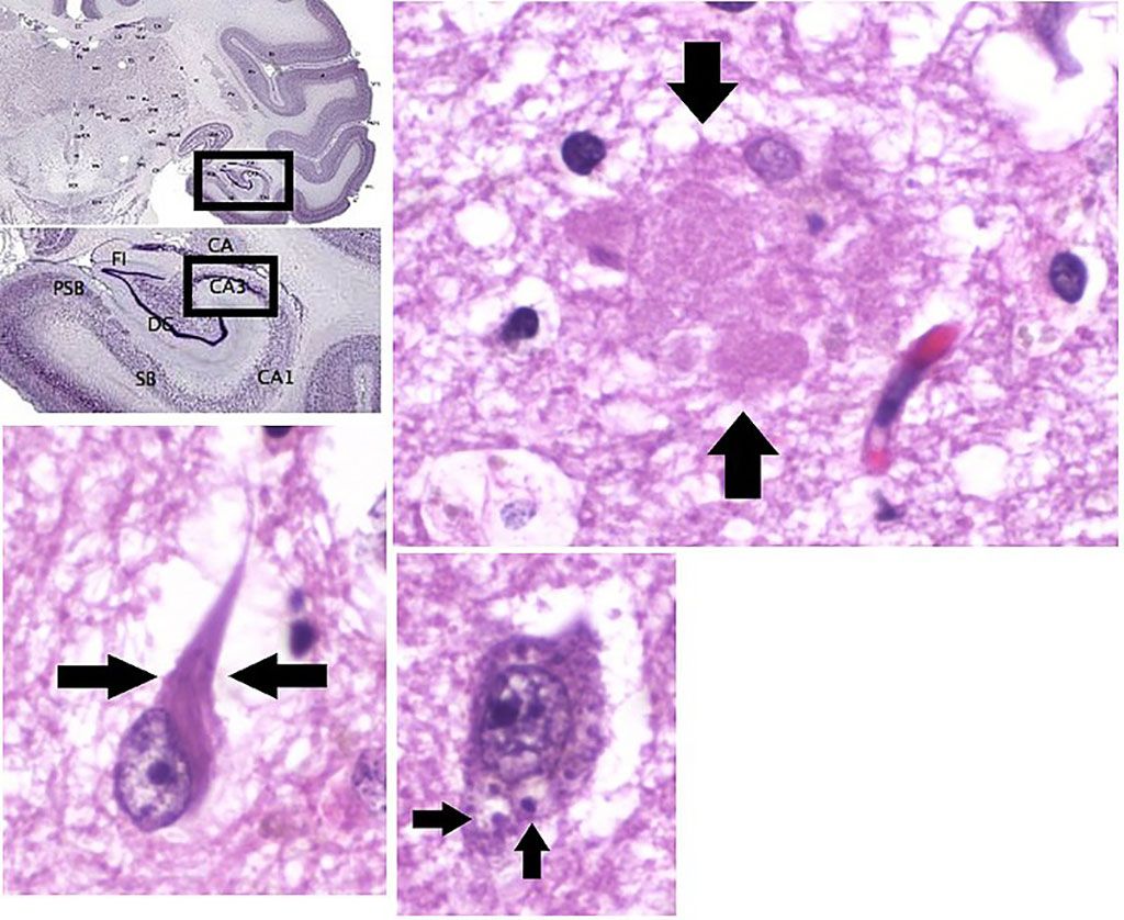 Imagen: Histopatología de la enfermedad de Alzheimer en el área CA3 del hipocampo: placa amiloide (arriba a la derecha), ovillos neurofibrilares (abajo a la izquierda) y degeneración granulovacuolar (abajo al centro). Las tres imágenes fueron tomadas con el mismo gran aumento (Fotografía cortesía de Wikimedia Commons)