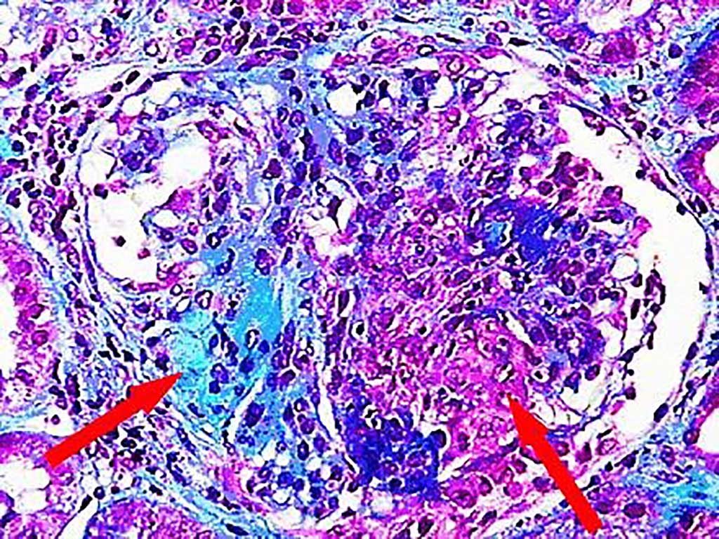 Imagen: Además de la localización periglomerular típica, una infiltración intersticial de leucocitos difusa es muy común en la vasculitis asociada a ANCA (Fotografía cortesía del Dr. Franco Ferrario y la Dra. Maria Pia Rastaldi)