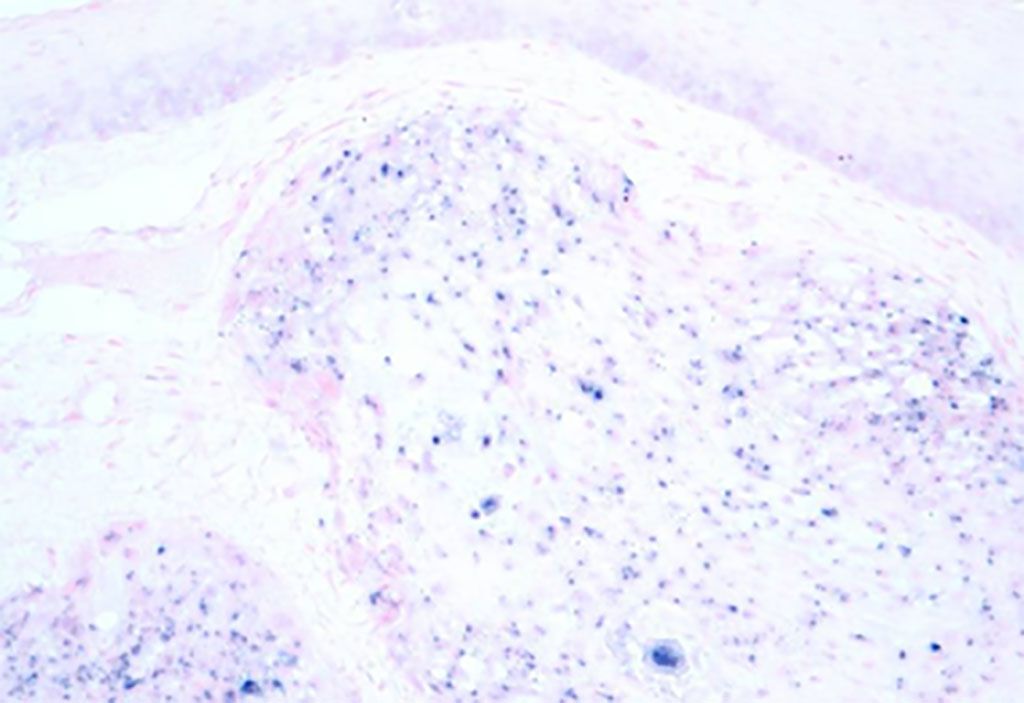 Imagen: Imagen de microfotografía de cáncer de orofaringe asociado al virus del papiloma humano (VPH+ OPSCC). El tejido se coloreó para mostrar la presencia del virus mediante hibridación in situ (Fotografía cortesía de Wikimedia Commons)