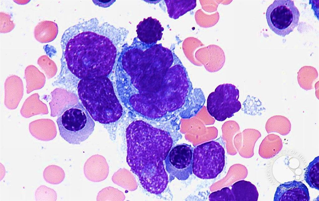 Imagen: Aspirado de médula ósea de un paciente con linfoma difuso de células B grandes (Fotografía cortesía del Dr. Peter G. Maslak, MD)