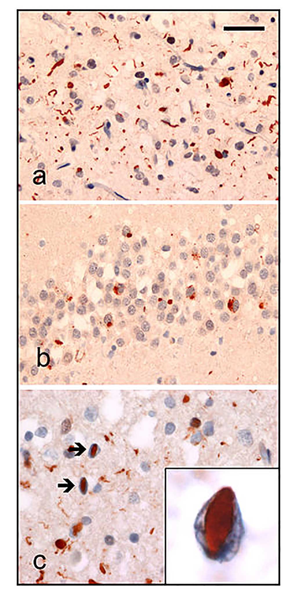 Imagen: Análisis neuropatológico del tejido cerebral de pacientes con FTLD. La inmunohistoquímica de ubiquitina en casos de FTLD familiar demuestra coloración de (a) neuritas e inclusiones citoplasmáticas neuronales en la neocorteza cerebral superficial, (b) inclusiones citoplásmicas neuronales en células granulares dentadas del hipocampo y (c) inclusiones intranucleares neuronales en la neocorteza cerebral (flechas) (Fotografía cortesía de Wikimedia Commons)