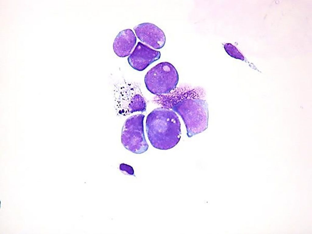 Imagen: Pequeñas células tumorales redondas de color azul encontradas en el LCR de un paciente con enfermedad leptomeníngea por rabdomiosarcoma (Fotografía cortesía de Oncología Pediátrica)