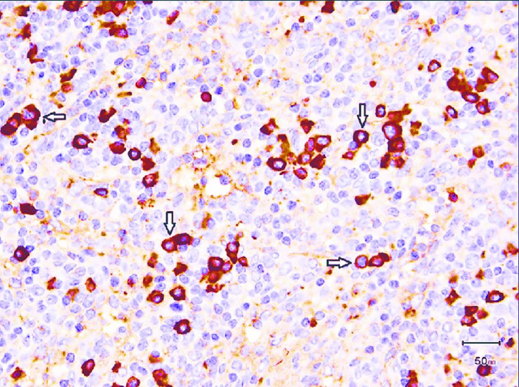 Imagen: Coloración inmunohistoquímica que muestra células plasmáticas positivas para IgG4 (flechas blancas) de una niña con mesenteritis esclerosante (Fotografía cortesía de la Universidad de Ciencias de la Salud Rey Saud bin Abdulaziz)