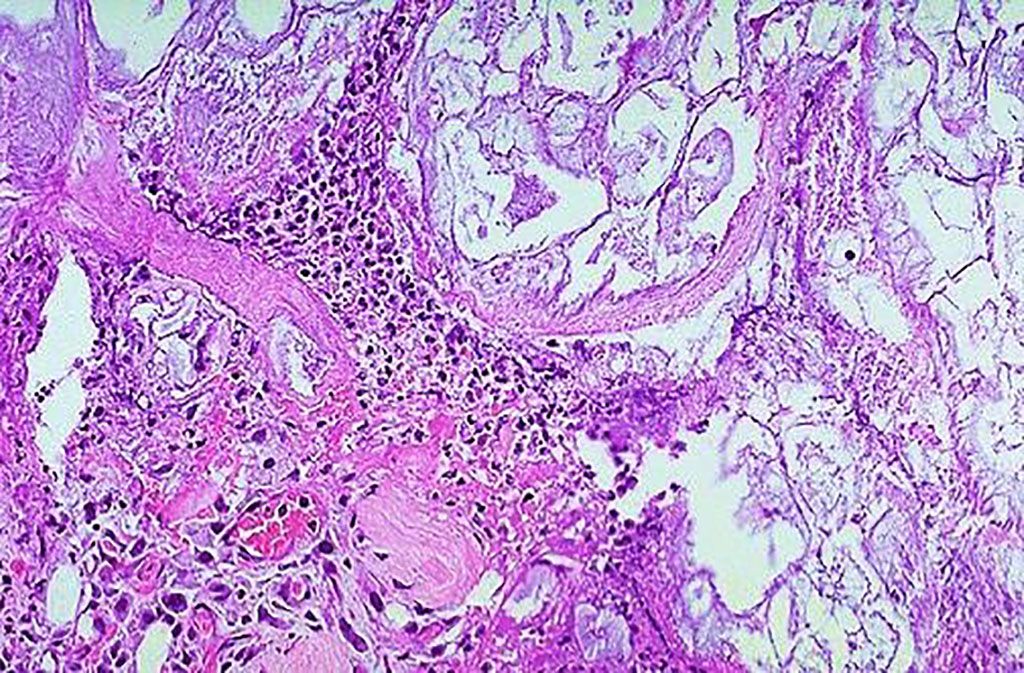 Imagen: Histopatología de la pancreatitis aguda: necrosis del parénquima pancreático (parte inferior izquierda) con inflamación aguda y necrosis grasa (parte derecha y superior de la fotografía) (Fotografía cortesía de la Facultad de Medicina de la Universidad de Estado de Florida)