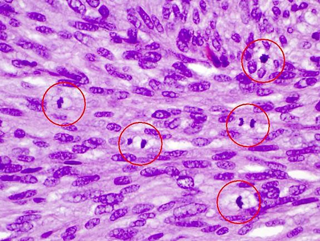 Imagen: Tasa mitótica y diagnóstico de melanoma: cuanto mayor sea el recuento mitótico (encerrado en un círculo), es más probable que el tumor haya hecho metástasis (Fotografía cortesía de Arlen Ramsey)