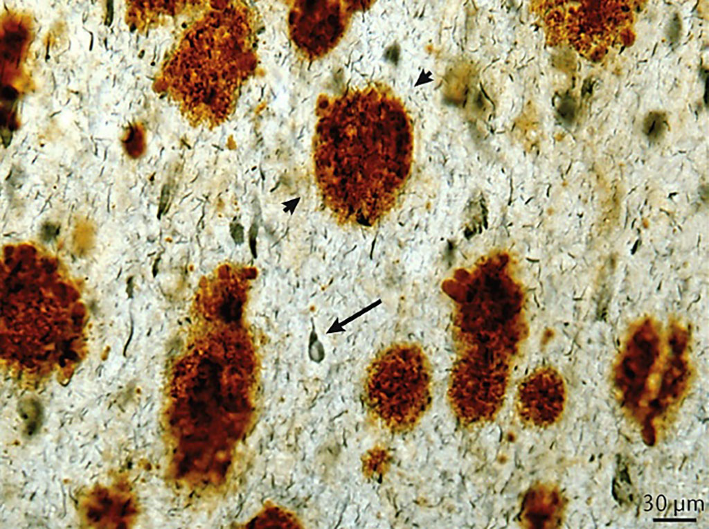 Imagen: Ejemplo representativo de placas de β-amiloide (Aβ1-42; coloración marrón; puntas de flecha) y ovillos neurofibrilares (anticuerpo PHF1; coloración azul; flecha) en la corteza frontal de una persona de 46 años con síndrome de Down y enfermedad de Alzheimer en etapa terminal. (Fotografía cortesía de la Universidad de California, Irvine).