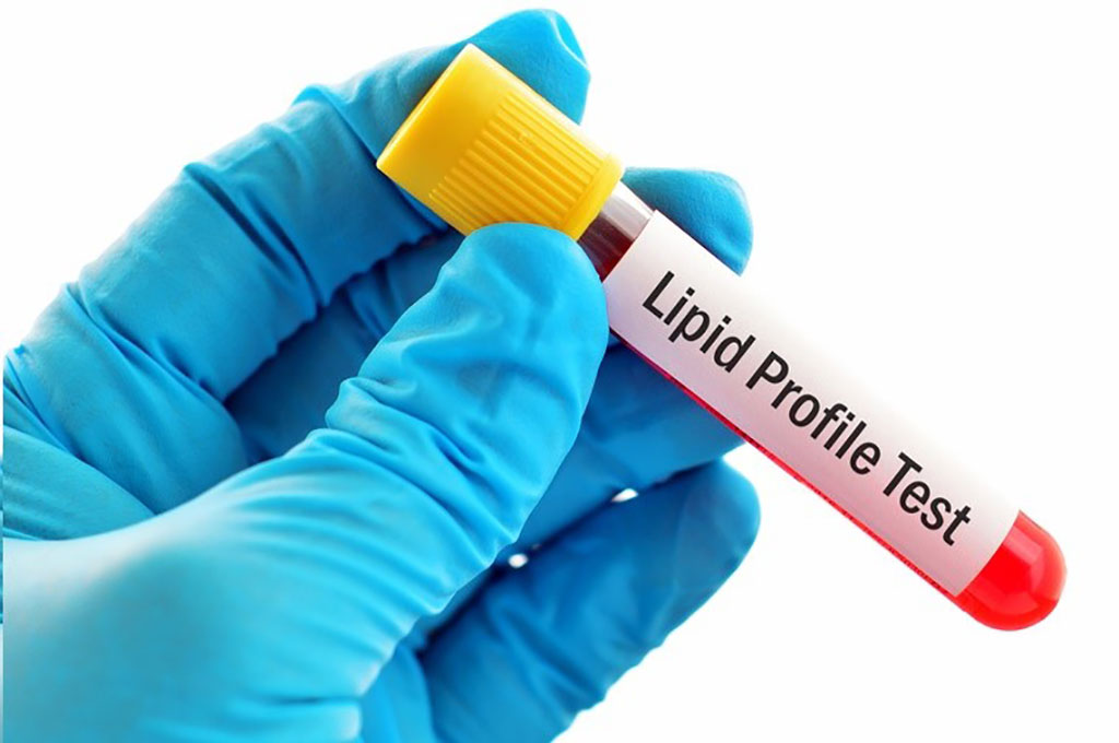 Imagen: Los niveles más altos de lipoproteínas de alta densidad y apolipoproteína A1 en sangre se asocian con un riesgo reducido de desarrollar esclerosis lateral amiotrófica (Fotografía cortesía de Forth)