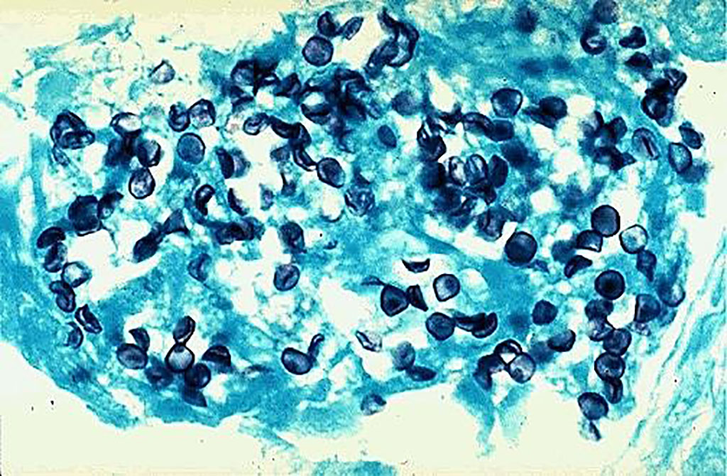 Microfotografía de quistes de Pneumocystis jirovecii teñidos con la coloración especial de plata de Grocott-Gomori metenamina del epitelio pulmonar que muestra numerosos organismos pequeños en forma de disco (Fotografía cortesía de Michelle N Kelly, PhD, y Judd E Shellito, MD)