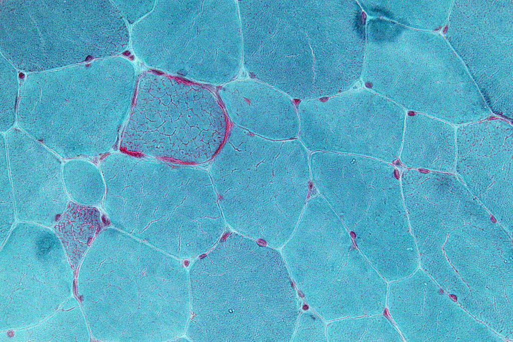 Imagen: Micrografía de gran aumento de una muestra de una biopsia muscular que muestra fibras rojas rasgadas, un hallazgo que se observa en varios tipos de enfermedades mitocondriales (Fotografía cortesía de Wikimedia Commons).