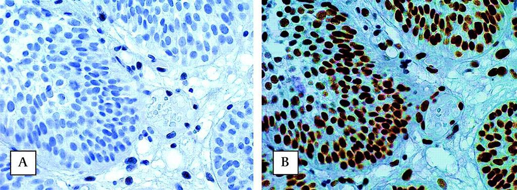 Imagen: Ausencia de coloración inmunohistoquímica nuclear de la proteína MSH2 (A) y presencia de la proteína MLH1 (B) en el carcinoma de células uroteliales de la vejiga urinaria de un paciente portador de una mutación de la línea germinal de MSH2. Observe la coloración nuclear en las células estromales como control interno (Fotografía cortesía del Centro Médico de la Universidad de Radboud en Nijmegen)