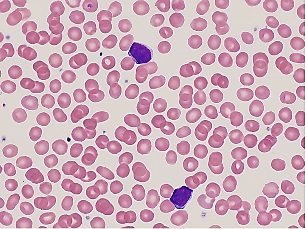 Imagen: Frotis de sangre de un paciente con linfocitosis monoclonal de células B. Los linfocitos circulantes atípicos están maduros con un pequeño borde de citoplasma basófilo. La población monoclonal de células B en la sangre es inferior a 5 × 109/L (Fotografía cortesía de Elizabeth Courville, MD)