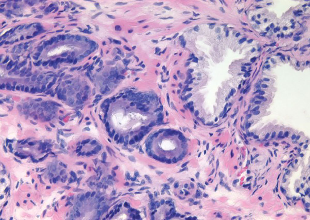 Imagen: Histopatología de adenocarcinoma de próstata en biopsia con aguja que consta de glándulas pequeñas con citoplasma anfofílico (Fotografía cortesía del profesor Jonathan I. Epstein, MD).