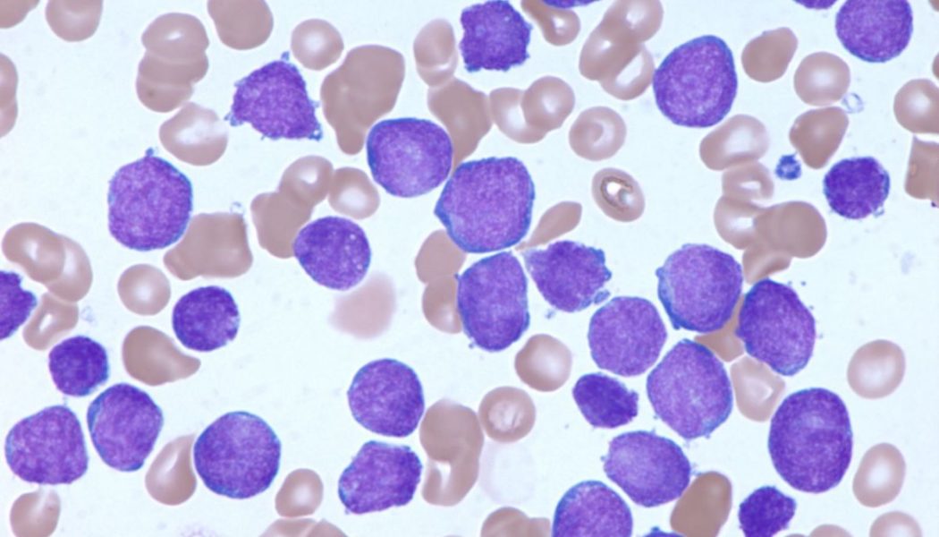 Imagen: Microfotografía de un frotis de sangre de un paciente con leucemia linfoide aguda (Fotografía cortesía del Hospital Infantil de Investigación St Jude).