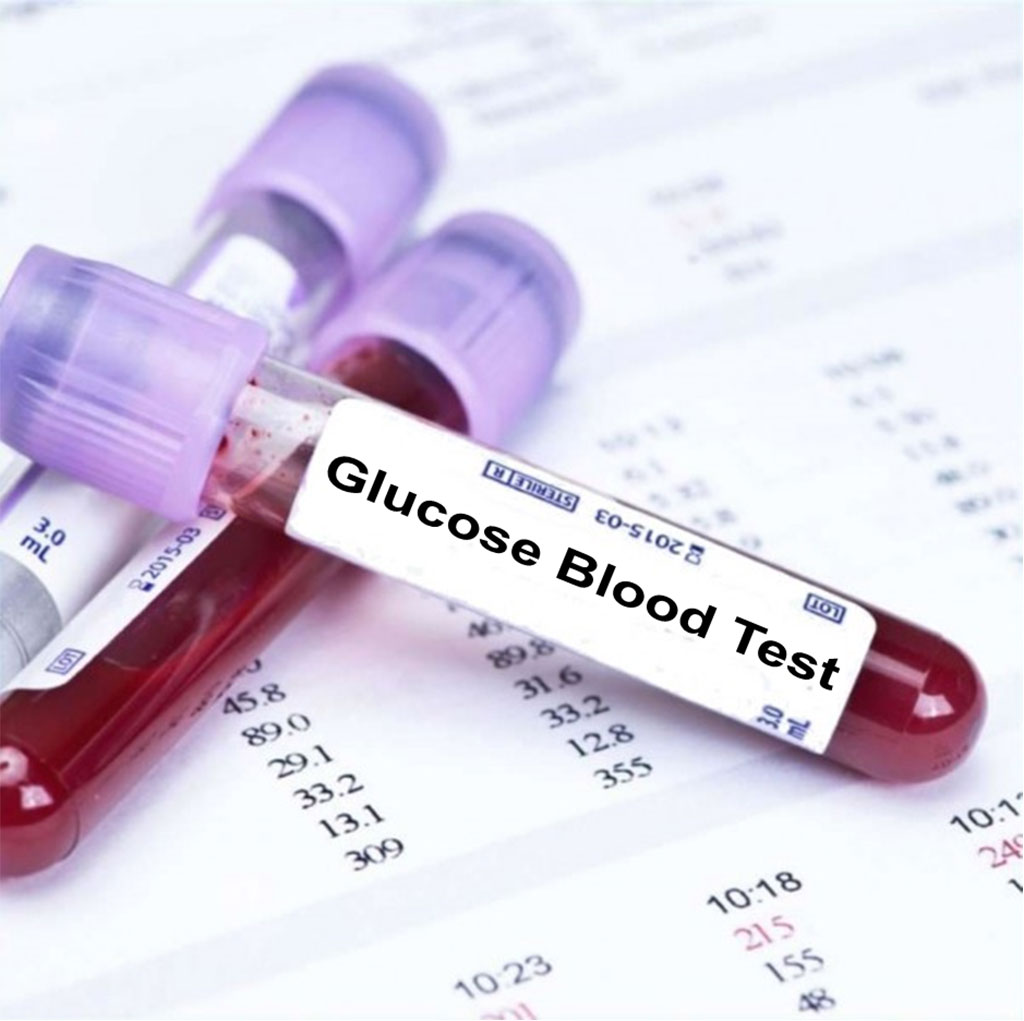 Imagen: La glucosa sérica identifica a los pacientes con accidente cerebrovascular hospitalizados con mayor riesgo de recurrencia (Fotografía cortesía de Blood Tests London).
